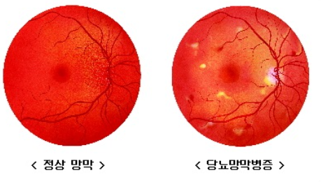 당뇨병성 망막병증